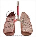 Αντιφυματικά φάρμακα Αντιφυματικά φάρμακα